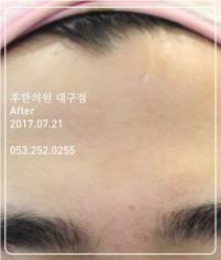 전후사진
