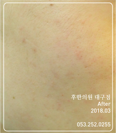 전후사진