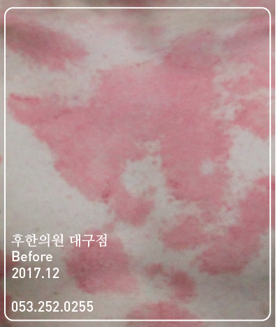 치료 전
