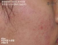 전후사진