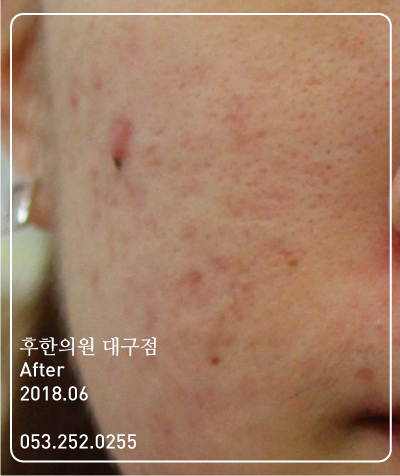 전후사진