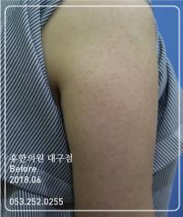 치료 전