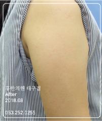 치료 후