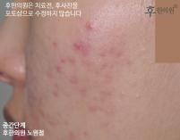 전후사진