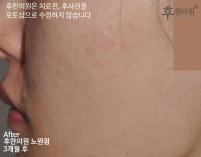 전후사진