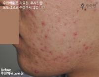 전후사진