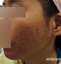 치료 전