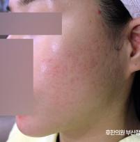치료 후