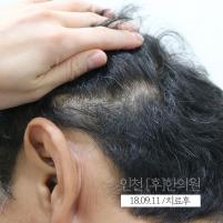 치료 후