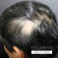치료 전