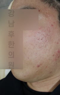 치료 전