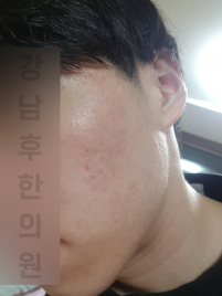 치료 후