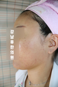 치료 후