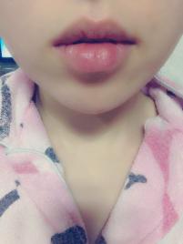 치료 후