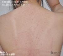 치료 전