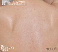 치료 후