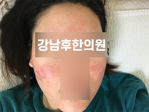 치료 후