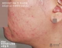 치료 후
