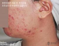 치료 전