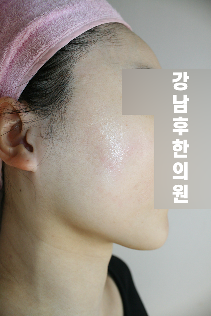 치료 후