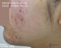치료 전