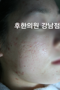 치료 전