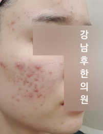 치료 전