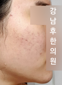 치료 후