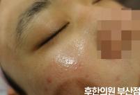 치료 후