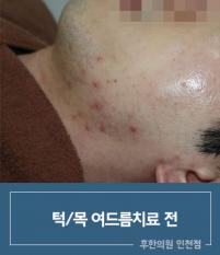 치료 전
