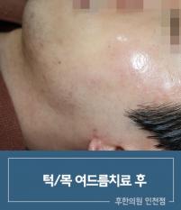 치료 후