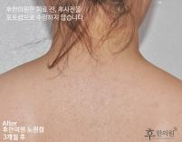 치료 후