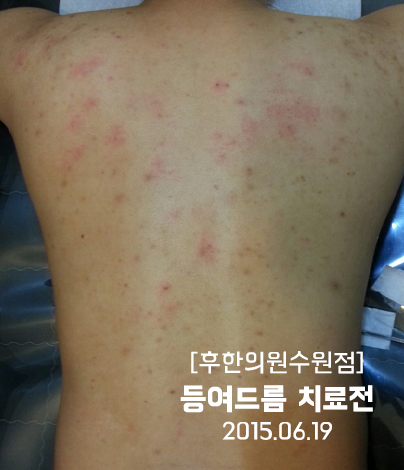 치료 전