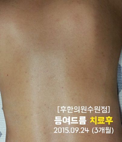 치료 후