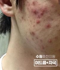 치료 전