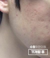 치료 후