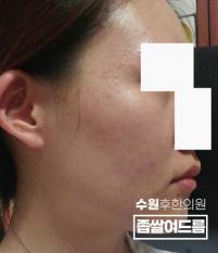 치료 전