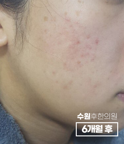 치료 후