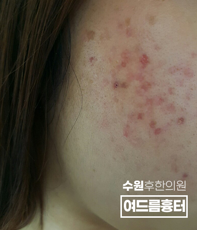 치료 전