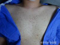 치료 전