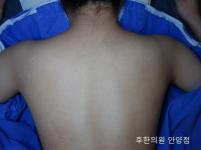 치료 후