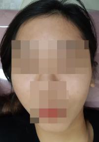 치료 후