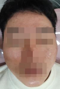 치료 후