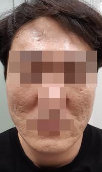 치료 전
