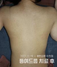 치료 후