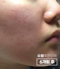 치료 후