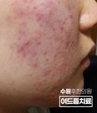 치료 전