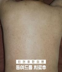 치료 후