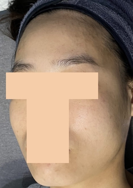 치료 후