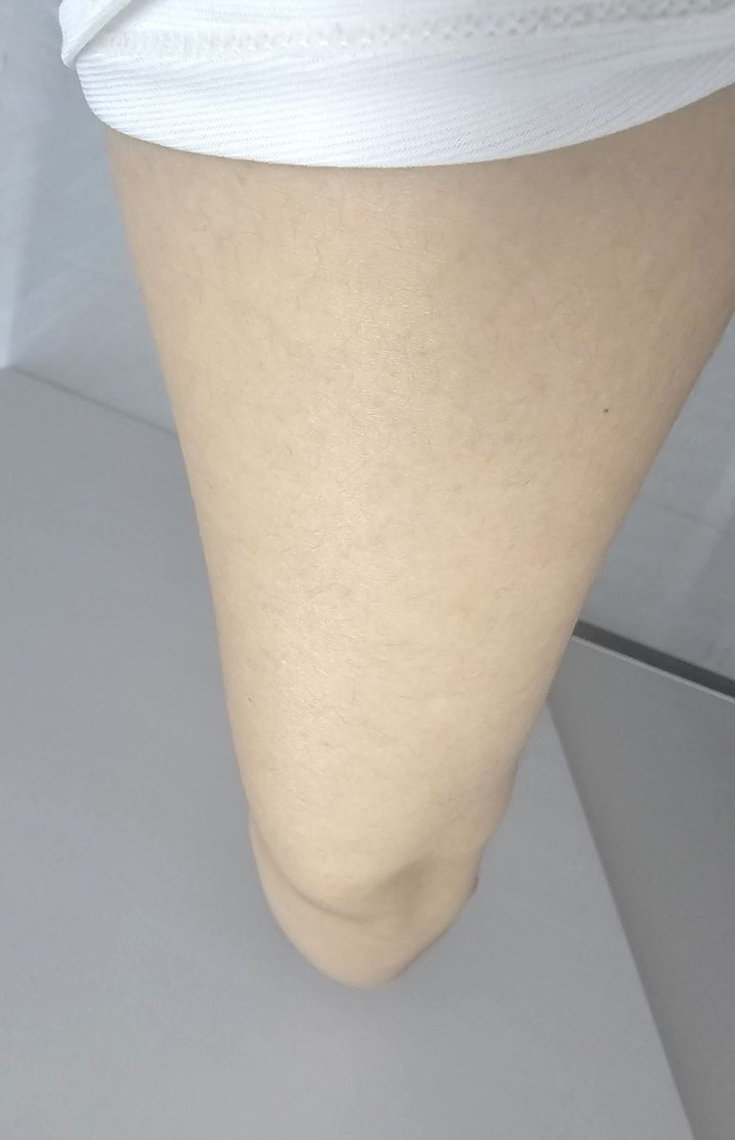 치료 후